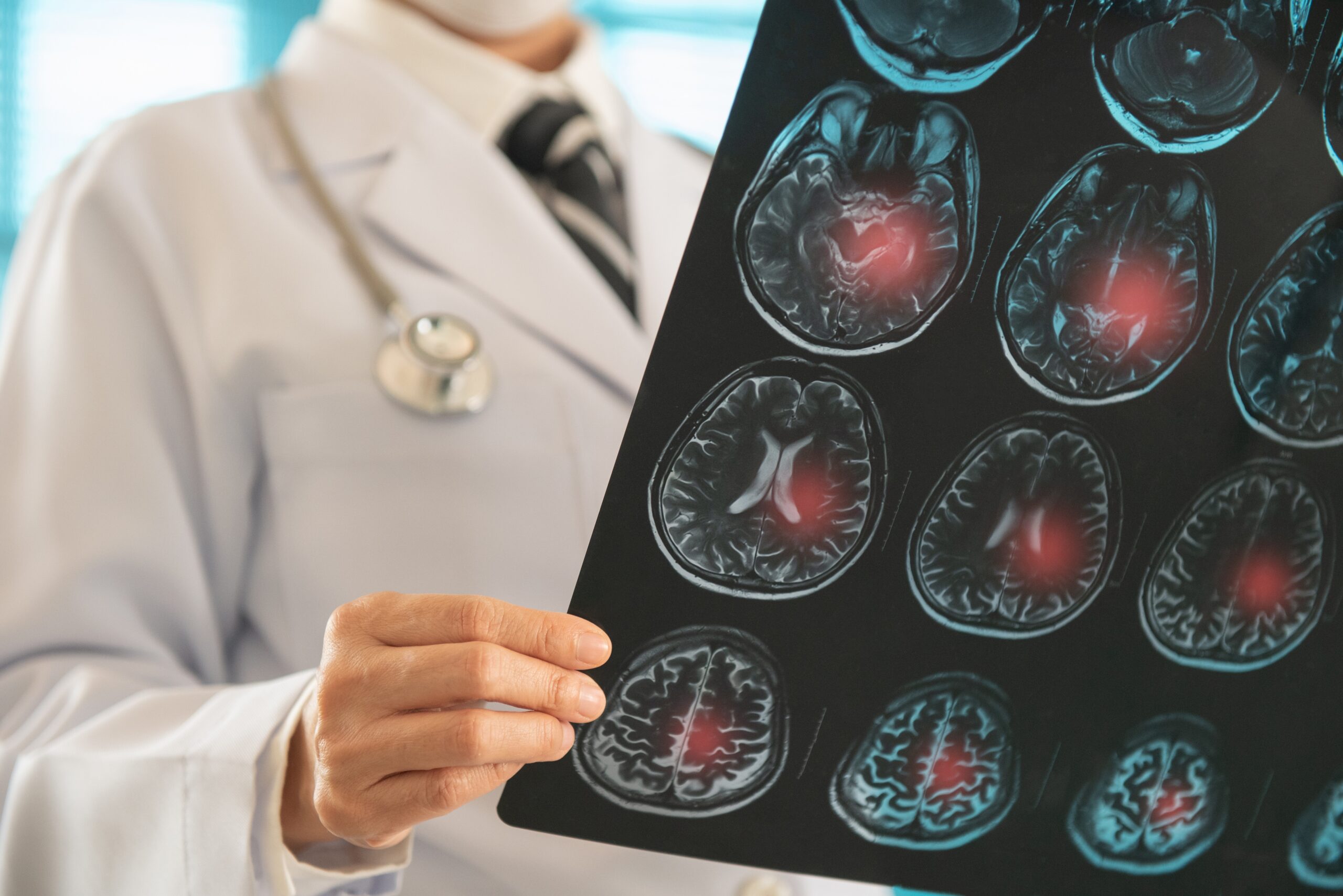 Doctor,Radiology,Looking,Stroke,Brain,X-ray,Image,For,Diagnose,Ischemic