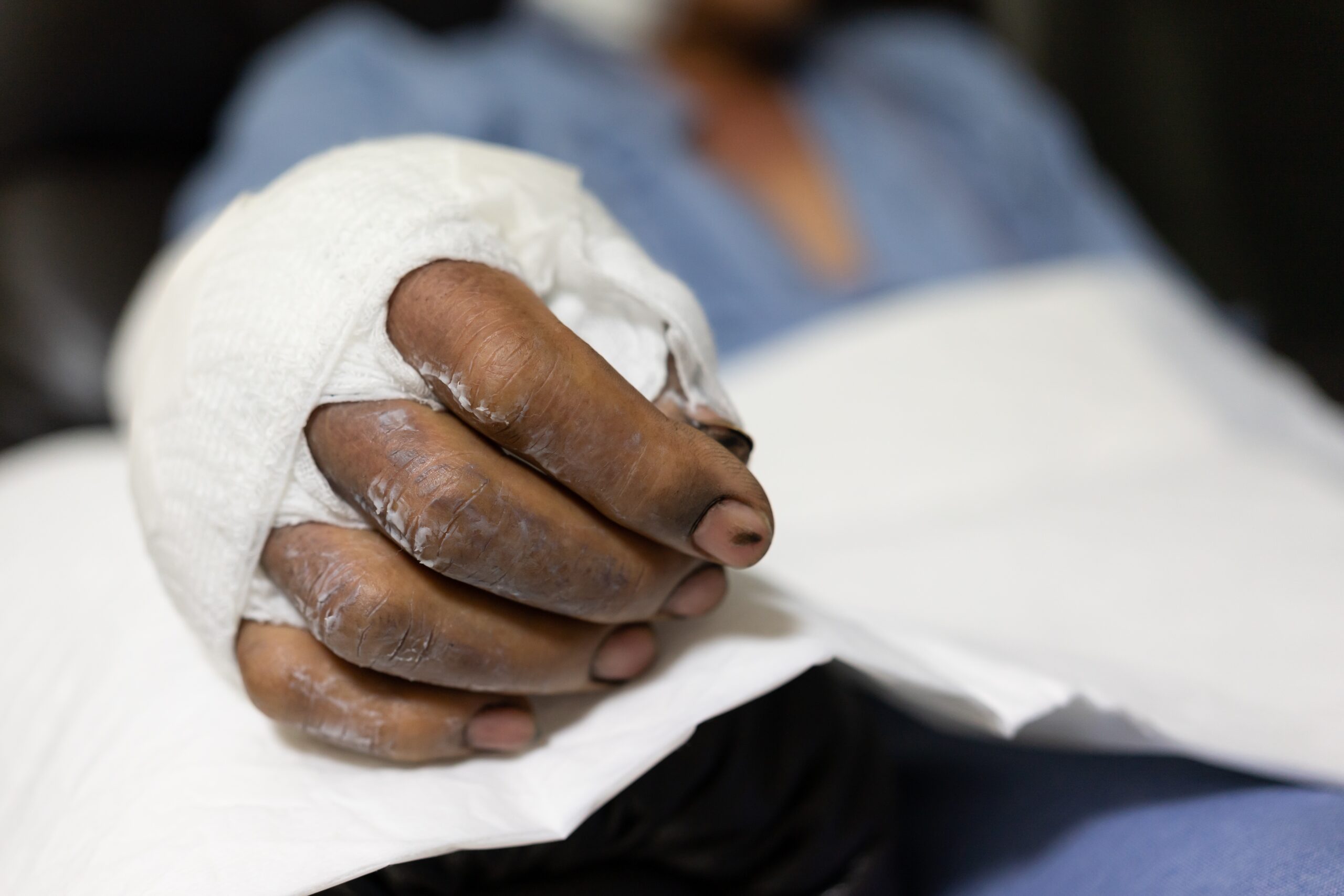 Patient,With,Burns,In,The,Hospital.,Applying,Bandage,Onto,Patient's