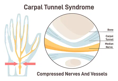 Carpal tunnel syndrome